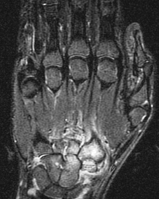 Figure 3 for case Juvenile idiopathic arthritis
